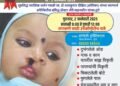 पुण्यात मोफत प्लॉस्टिक सर्जरी शिबीराचे आयोजन